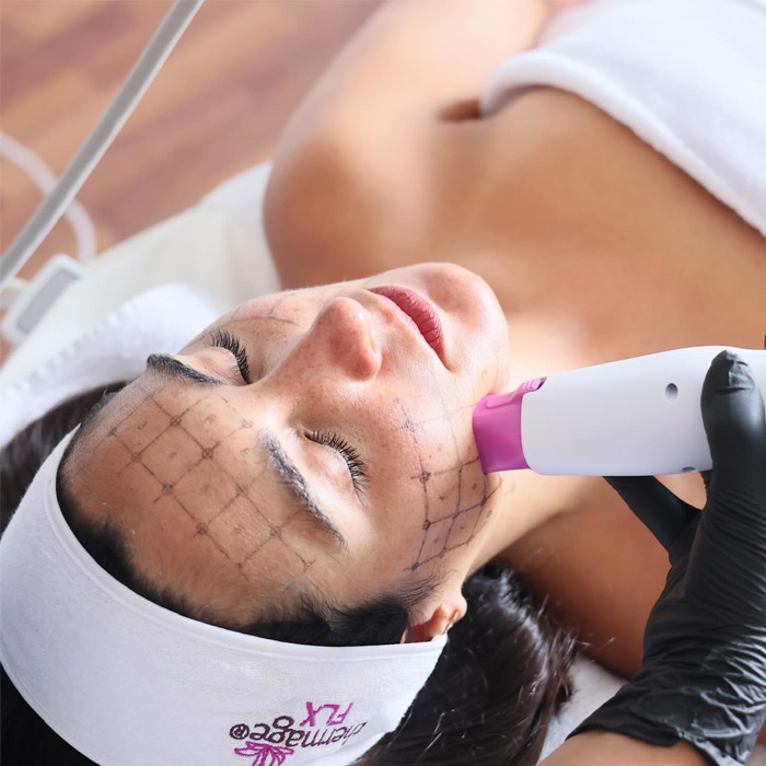 Radiofrecuencia Thermage FLX